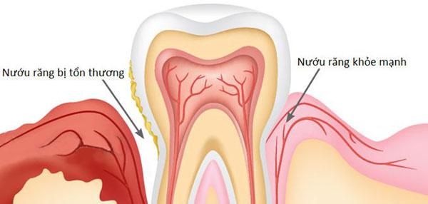 Răng bị mẻ thì phải làm sao