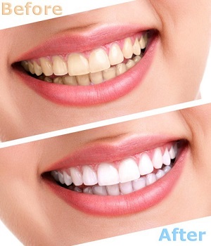 Top những công nghệ tẩy trắng răng hiệu quả nhất hiện nay