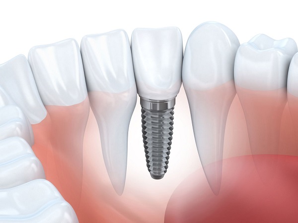 Trường hợp nào nên trồng Implant cho răng