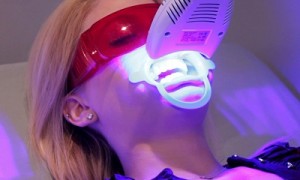 Tẩy trắng răng tại phòng khám bằng đèn laser